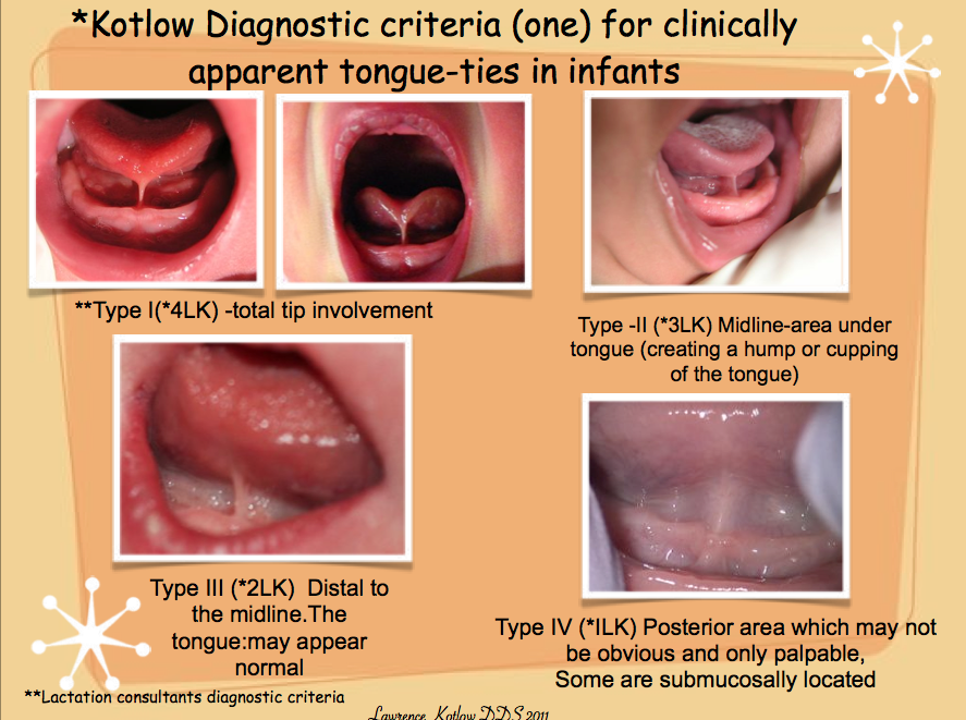 how-to-diagnose-tongue-and-lip-ties-3_1